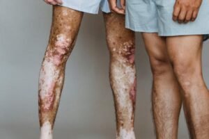 2 men in their boxer shorts one with with visible vitiligo and Psoriasis