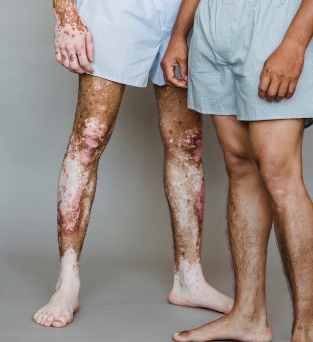 2 men in their boxer shorts one with with visible vitiligo and Psoriasis