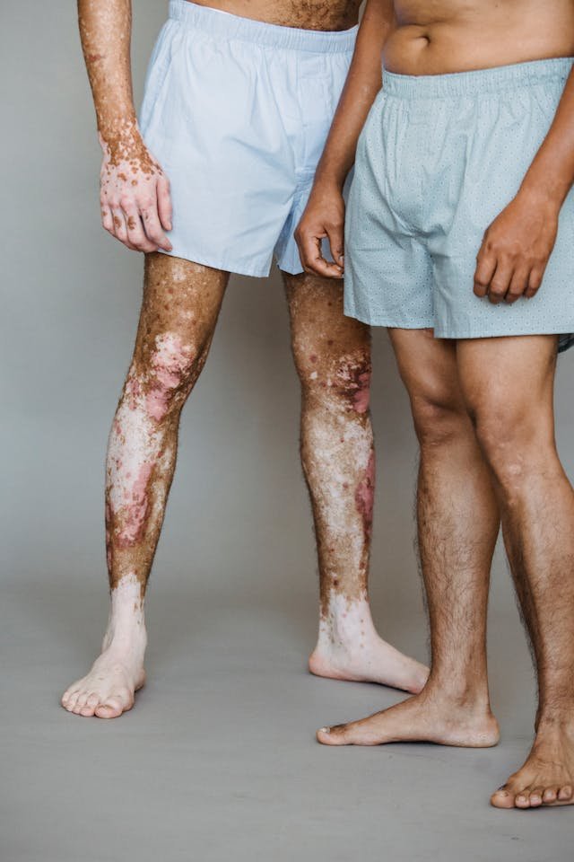 2 men in their boxer shorts one with with visible vitiligo and Psoriasis