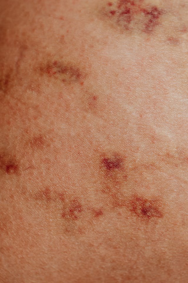 A picture of someone's skin showing an eczema rash